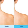 Differin Acne Body Spray, Acne Treatment with Salicylic Acid by the makers of Differin Gel, 360 Formula for Back Acne, Chest and Shoulders, 6 oz | 360 Degree Spray Targets Back, Chest, Shoulders, Salicylic Acid Body Acne Treatment, Dermatologist-Developed, 6 Oz